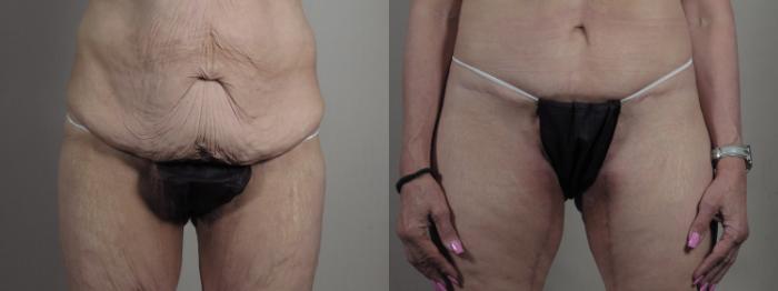 Breast Lift with Implants Case 1301 Before & After front  | Paramus, New Jersey | Parker Center for Plastic Surgery
