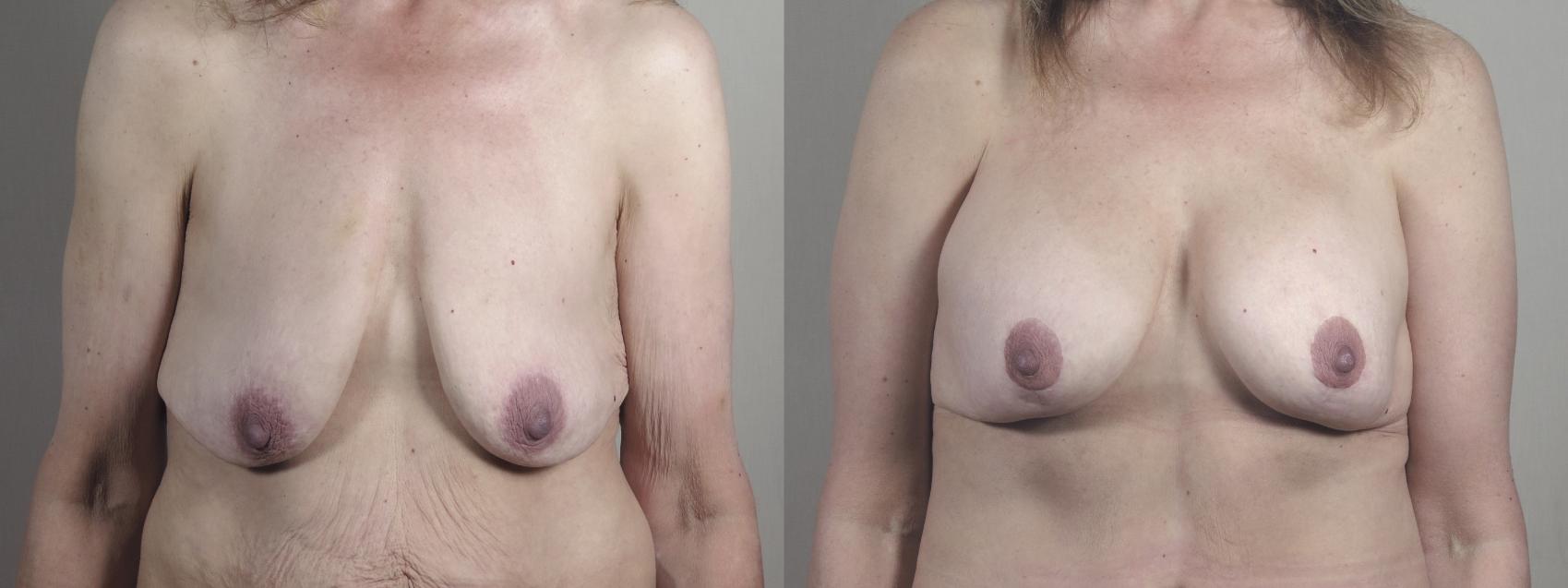 Breast Lift with Implants Case 1301 Before & After Front | Paramus, New Jersey | Parker Center for Plastic Surgery