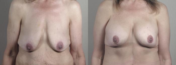 Breast Lift with Implants Case 1301 Before & After Front | Paramus, New Jersey | Parker Center for Plastic Surgery