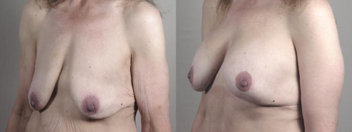 Breast Lift with Implants Case 1301 Before & After Left Oblique | Paramus, New Jersey | Parker Center for Plastic Surgery