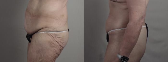 Breast Lift with Implants Case 1301 Before & After Left Side | Paramus, New Jersey | Parker Center for Plastic Surgery
