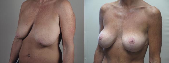 Breast Lift with Implants Case 1412 Before & After . | Paramus, New Jersey | Parker Center for Plastic Surgery