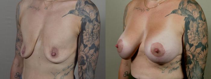 Breast Lift with Implants Case 1522 Before & After Left Oblique | Paramus, New Jersey | Parker Center for Plastic Surgery