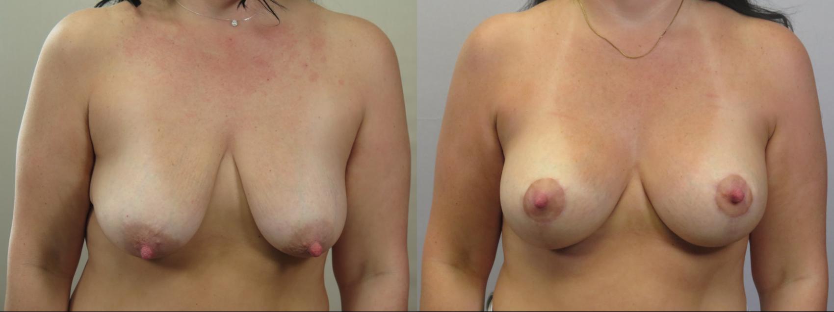 Breast Lift with Implants Case 1586 Before & After Front | Paramus, New Jersey | Parker Center for Plastic Surgery