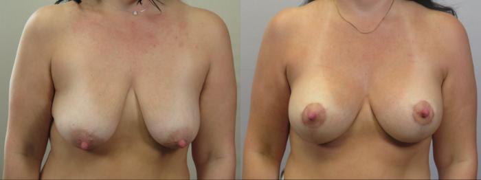 Breast Lift with Implants Case 1586 Before & After Front | Paramus, New Jersey | Parker Center for Plastic Surgery