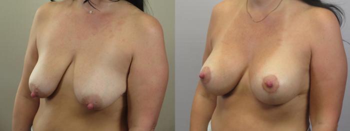 Breast Lift with Implants Case 1586 Before & After Left Oblique | Paramus, New Jersey | Parker Center for Plastic Surgery