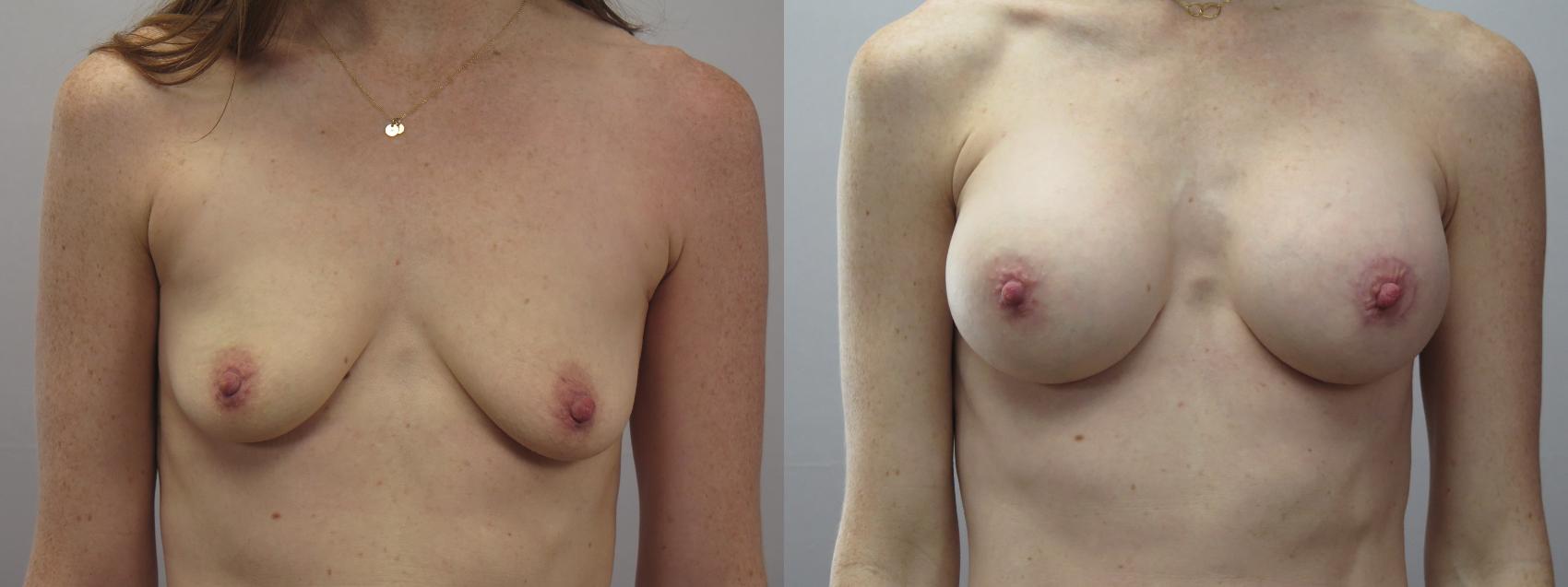 Breast Lift with Implants Case 1635 Before & After Front | Paramus, New Jersey | Parker Center for Plastic Surgery