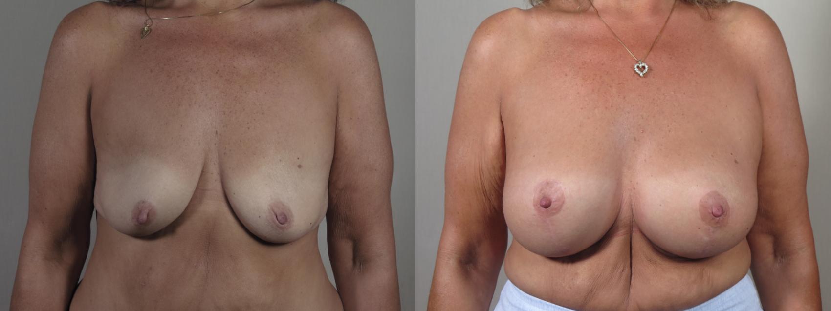 Breast Lift with Implants Case 1636 Before & After Front | Paramus, New Jersey | Parker Center for Plastic Surgery