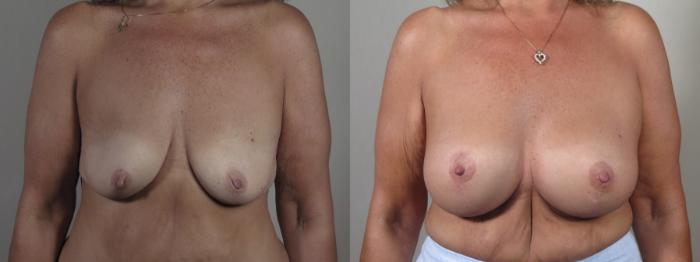 Breast Lift with Implants Case 1636 Before & After Front | Paramus, New Jersey | Parker Center for Plastic Surgery