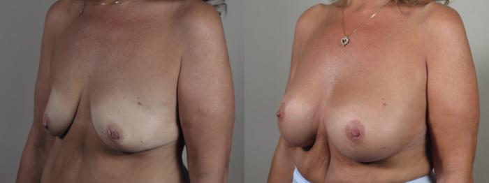 Breast Lift with Implants Case 1636 Before & After Left Oblique | Paramus, New Jersey | Parker Center for Plastic Surgery