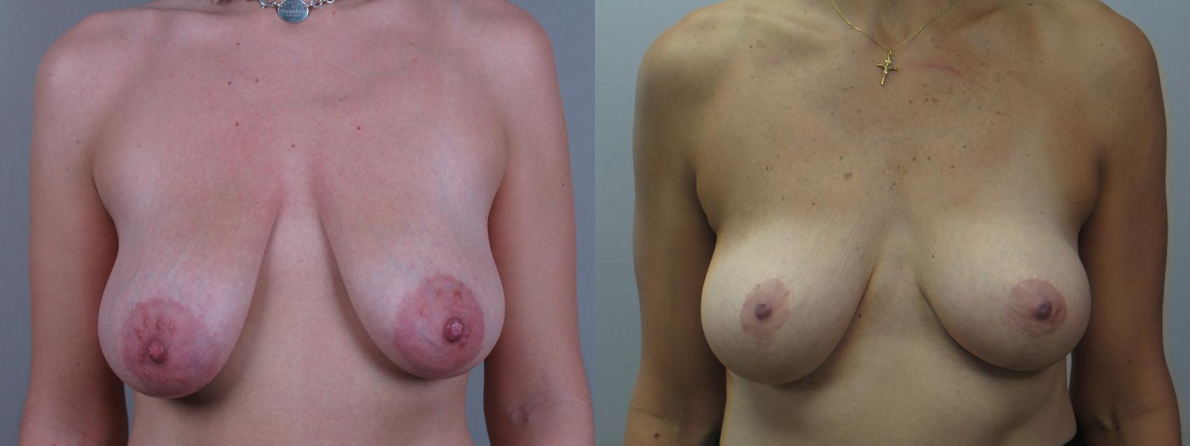 Breast Lift with Implants Case 1637 Before & After Front | Paramus, New Jersey | Parker Center for Plastic Surgery