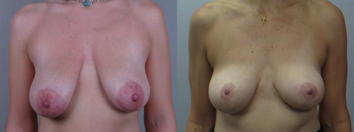 Breast Lift with Implants Case 1637 Before & After Front | Paramus, New Jersey | Parker Center for Plastic Surgery