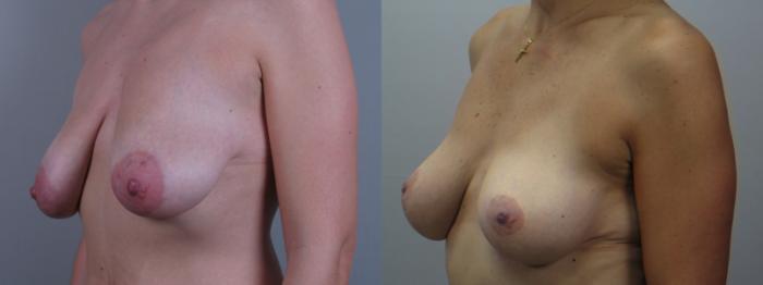 Breast Lift with Implants Case 1637 Before & After Left Oblique | Paramus, New Jersey | Parker Center for Plastic Surgery
