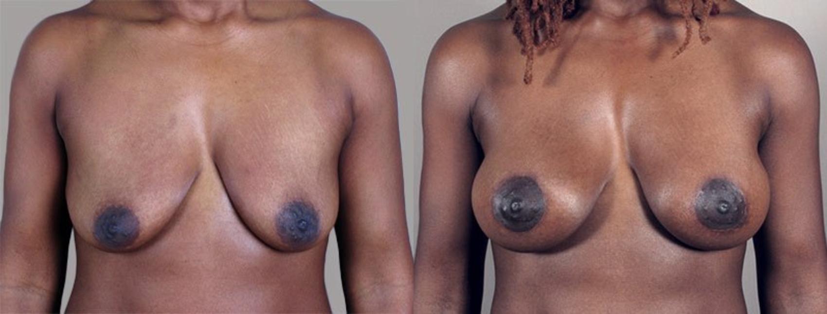 Breast Lift with Implants Case 449 Before & After View #1 | Paramus, New Jersey | Parker Center for Plastic Surgery