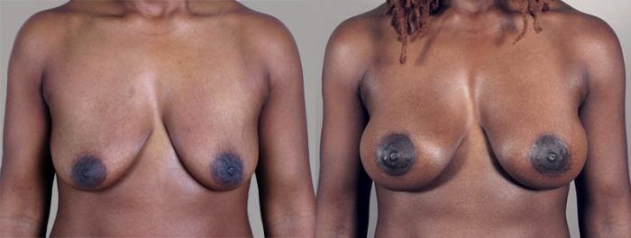 Breast Lift with Implants Case 449 Before & After View #1 | Paramus, New Jersey | Parker Center for Plastic Surgery