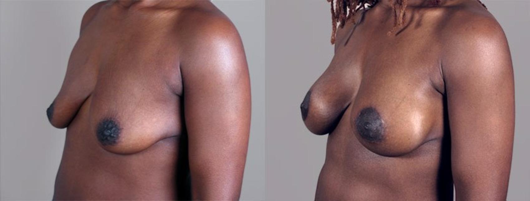 Breast Lift with Implants Case 449 Before & After View #2 | Paramus, New Jersey | Parker Center for Plastic Surgery