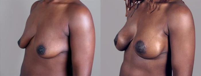 Breast Lift with Implants Case 449 Before & After View #2 | Paramus, New Jersey | Parker Center for Plastic Surgery