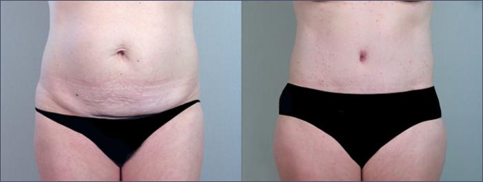 Breast Lift with Implants Case 450 Before & After View #2 | Paramus, New Jersey | Parker Center for Plastic Surgery