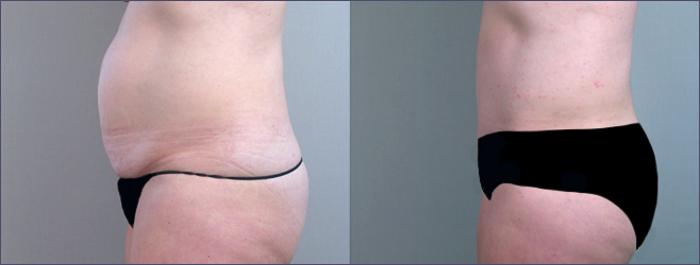 Breast Lift with Implants Case 450 Before & After View #3 | Paramus, New Jersey | Parker Center for Plastic Surgery