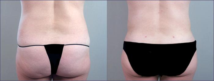 Breast Lift with Implants Case 450 Before & After View #4 | Paramus, New Jersey | Parker Center for Plastic Surgery