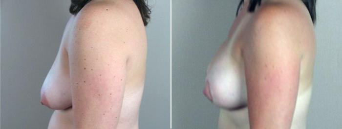 Breast Lift with Implants Case 450 Before & After View #5 | Paramus, New Jersey | Parker Center for Plastic Surgery
