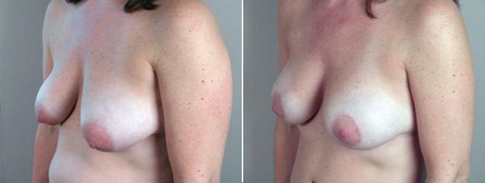 Breast Lift with Implants Case 450 Before & After View #6 | Paramus, New Jersey | Parker Center for Plastic Surgery