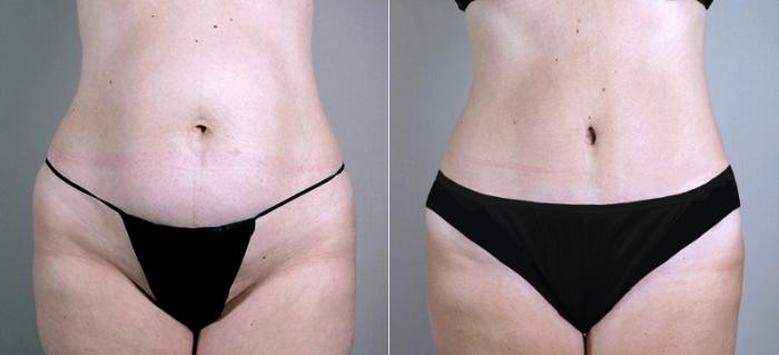 Breast Lift with Implants Case 452 Before & After View #3 | Paramus, New Jersey | Parker Center for Plastic Surgery