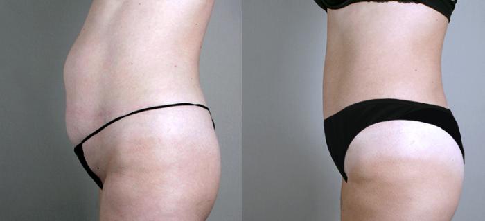Breast Lift with Implants Case 452 Before & After View #4 | Paramus, New Jersey | Parker Center for Plastic Surgery