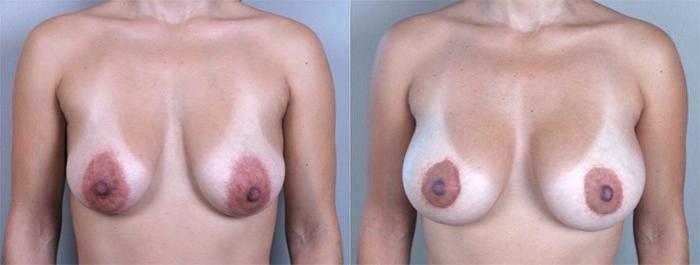 Breast Lift with Implants Case 453 Before & After View #1 | Paramus, New Jersey | Parker Center for Plastic Surgery