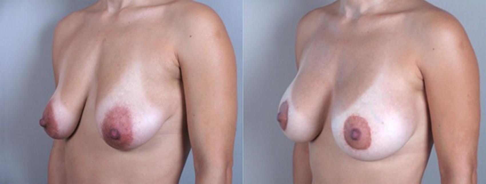 Breast Lift with Implants Case 453 Before & After View #2 | Paramus, New Jersey | Parker Center for Plastic Surgery