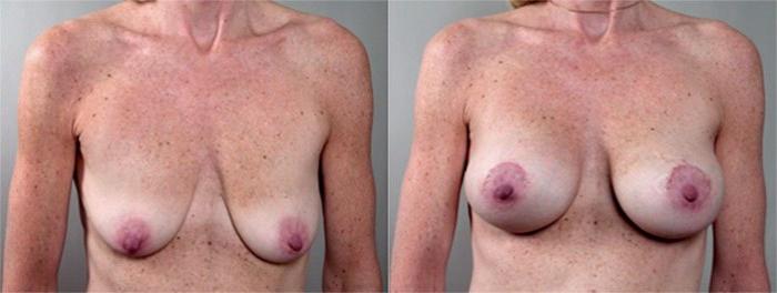 Breast Lift with Implants Case 455 Before & After View #1 | Paramus, New Jersey | Parker Center for Plastic Surgery
