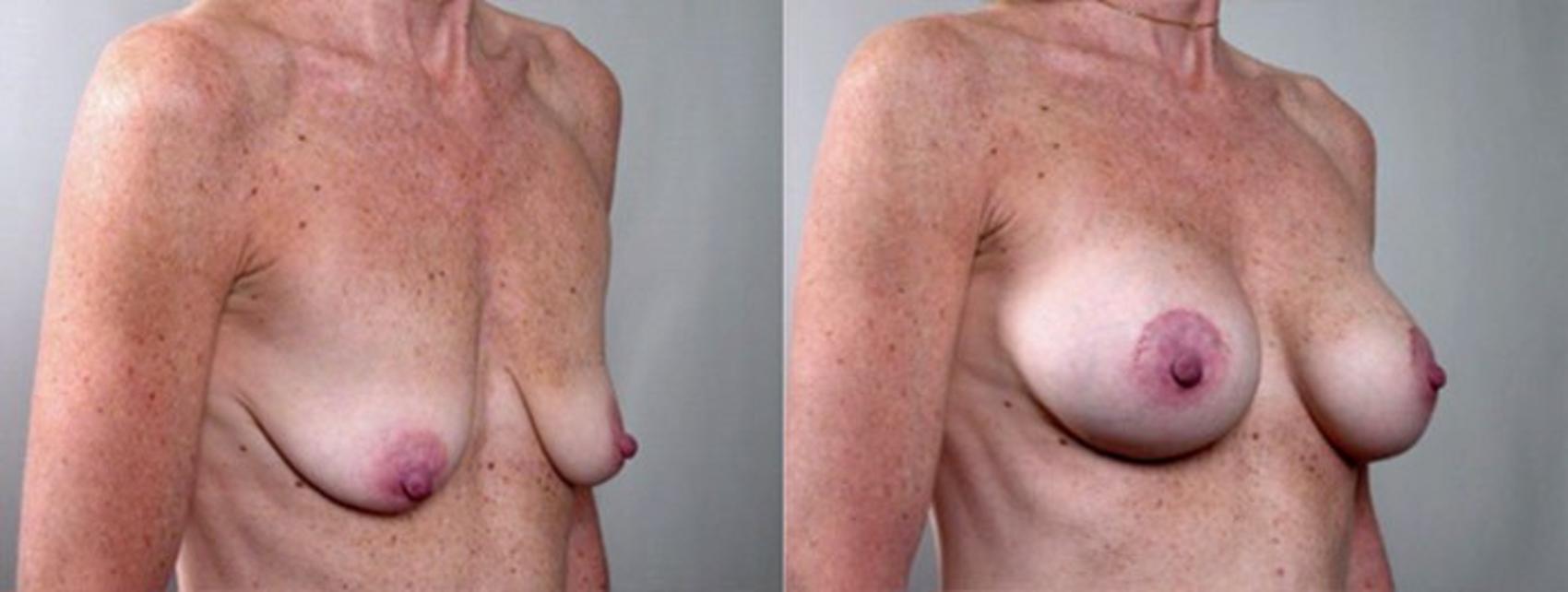 Breast Lift with Implants Case 455 Before & After View #2 | Paramus, New Jersey | Parker Center for Plastic Surgery