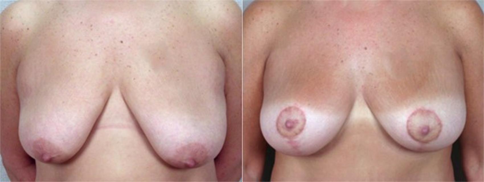 Breast Lift with Implants Case 456 Before & After View #1 | Paramus, New Jersey | Parker Center for Plastic Surgery