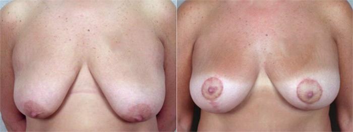 Breast Lift with Implants Case 456 Before & After View #1 | Paramus, New Jersey | Parker Center for Plastic Surgery