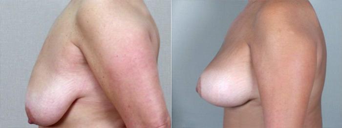 Breast Lift with Implants Case 456 Before & After View #2 | Paramus, New Jersey | Parker Center for Plastic Surgery