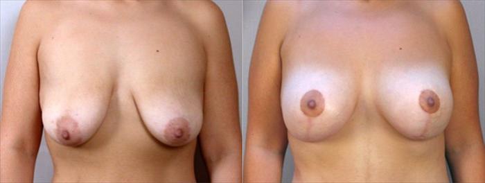Breast Lift with Implants Case 457 Before & After View #1 | Paramus, New Jersey | Parker Center for Plastic Surgery
