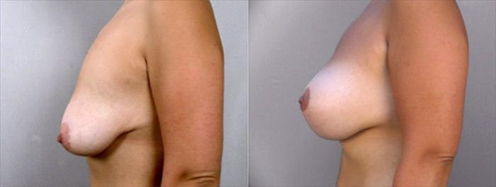 Breast Lift with Implants Case 457 Before & After View #2 | Paramus, New Jersey | Parker Center for Plastic Surgery