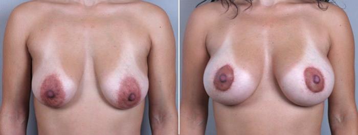 Breast Lift with Implants Case 458 Before & After View #1 | Paramus, New Jersey | Parker Center for Plastic Surgery
