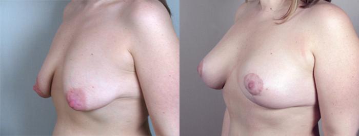 Breast Lift with Implants Case 459 Before & After View #2 | Paramus, New Jersey | Parker Center for Plastic Surgery