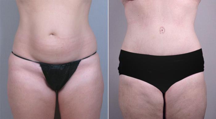 Breast Lift with Implants Case 459 Before & After View #3 | Paramus, New Jersey | Parker Center for Plastic Surgery