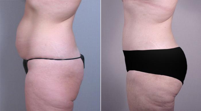 Breast Lift with Implants Case 459 Before & After View #4 | Paramus, New Jersey | Parker Center for Plastic Surgery