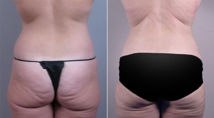 Breast Lift with Implants Case 459 Before & After View #5 | Paramus, New Jersey | Parker Center for Plastic Surgery