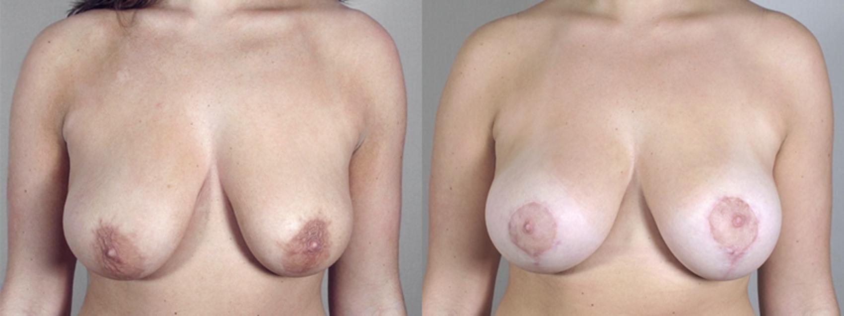 Breast Lift with Implants Case 462 Before & After View #1 | Paramus, New Jersey | Parker Center for Plastic Surgery