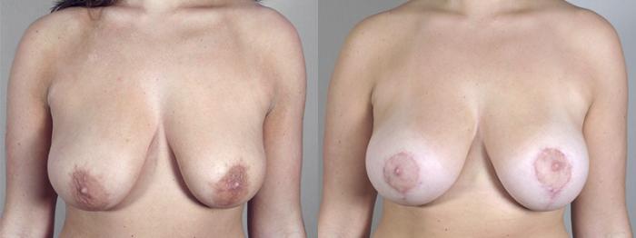 Breast Lift with Implants Case 462 Before & After View #1 | Paramus, New Jersey | Parker Center for Plastic Surgery