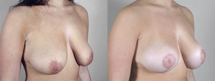 Breast Lift with Implants Case 462 Before & After View #2 | Paramus, New Jersey | Parker Center for Plastic Surgery