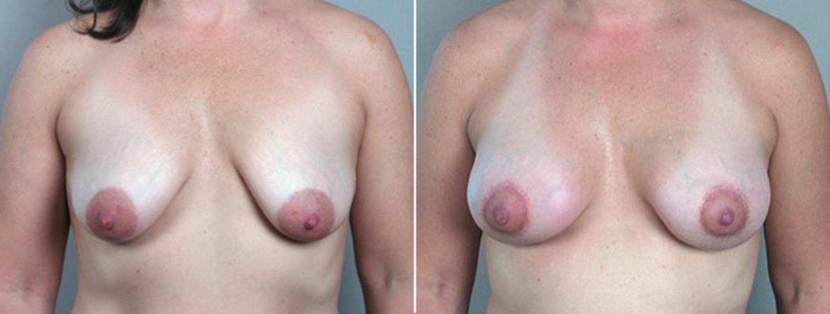 Breast Lift with Implants Case 463 Before & After View #1 | Paramus, New Jersey | Parker Center for Plastic Surgery