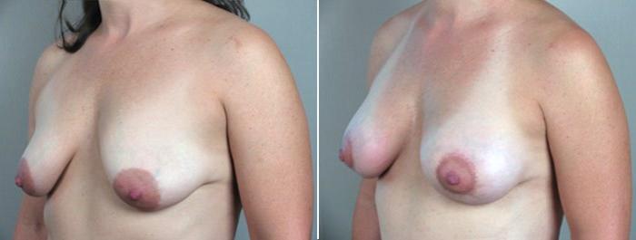 Breast Lift with Implants Case 463 Before & After View #2 | Paramus, New Jersey | Parker Center for Plastic Surgery