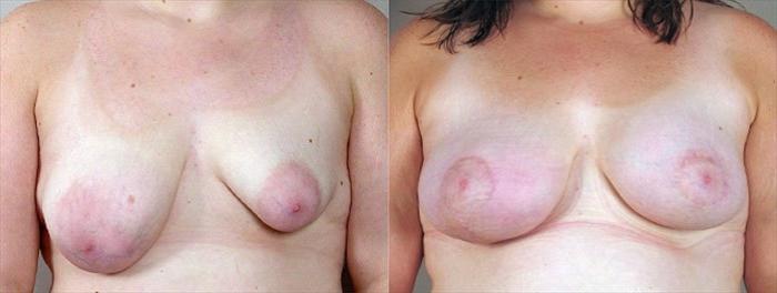 Breast Lift with Implants Case 464 Before & After View #1 | Paramus, New Jersey | Parker Center for Plastic Surgery