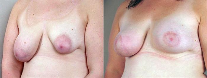 Breast Lift with Implants Case 464 Before & After View #2 | Paramus, New Jersey | Parker Center for Plastic Surgery