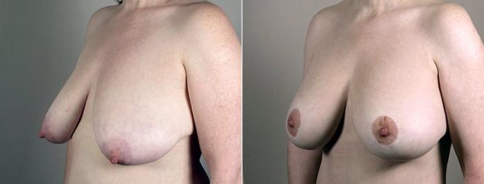 Breast Lift with Implants Case 466 Before & After View #2 | Paramus, New Jersey | Parker Center for Plastic Surgery